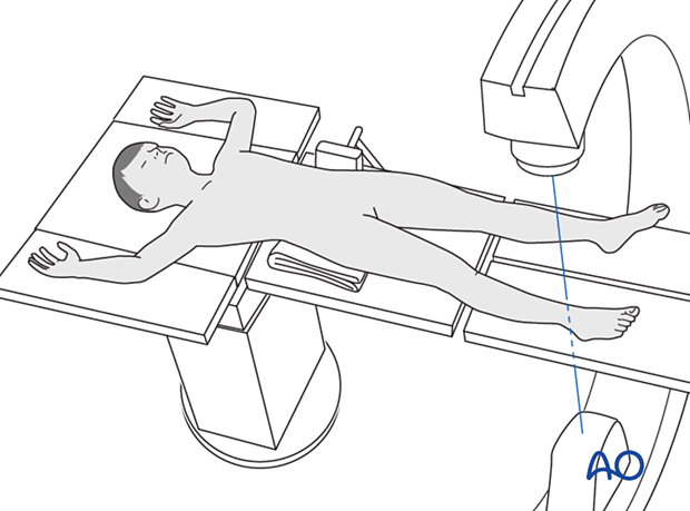Supine position of a pediatric patient for intraoperative imaging of the distal tibia and fibula