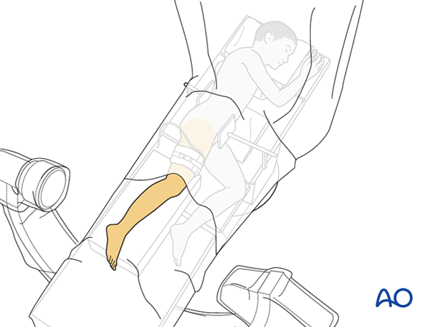 Skin preparation and draping of the leg of a pediatric patient in lateral decubitus position