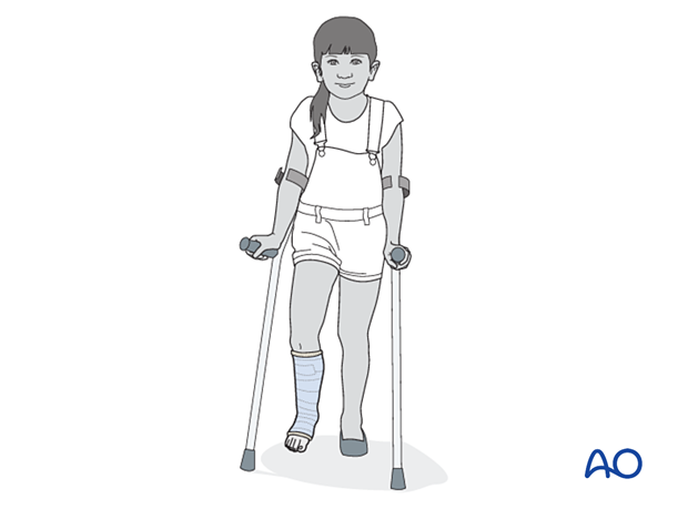 Pediatric patient walking with crutches and a short leg cast for immobilization of the ankle
