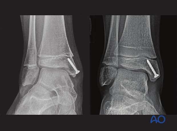 Harris growth arrest line in the distal tibia of a 10-year-old patient, 6 months after injury (right image)