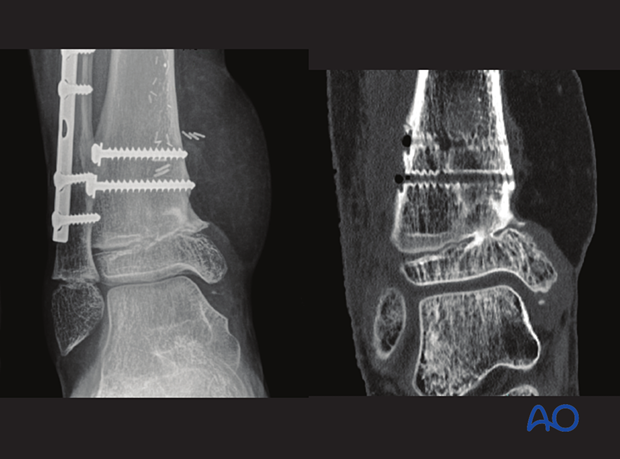 Growth disturbance (convergent Harris lines) of an open Salter-Harris II fracture of the distal tibia in a 10-year-old patient, 6 months after injury
