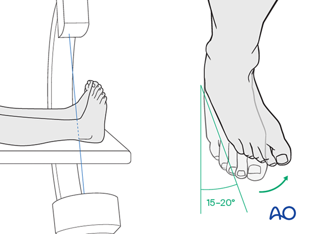 The mortise view is an AP view of the ankle with 15°–20° internal rotation of the foot.
