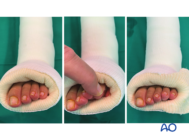 In the left and middle image, the pinky toe is hidden. Revision of the cast exposes all toes.