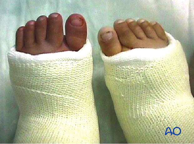 This case shows a cast applied too tight (left foot).
