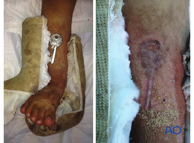 This case shows the pressure sore caused by a key inserted between the cast and the skin.