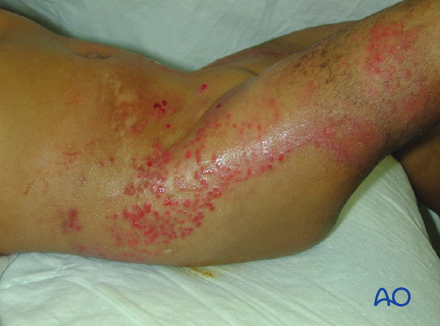 This case shows dermatitis after casting.