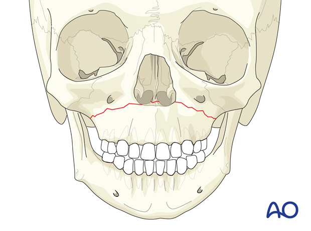 Pediatric Le Fort fracture.