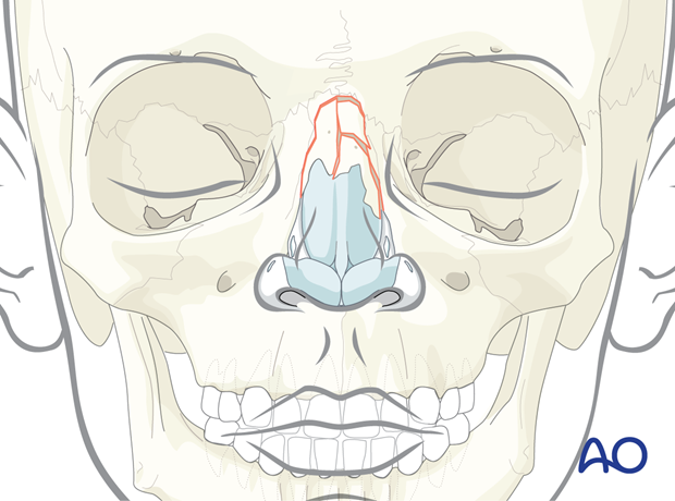 Pediatric nasal bone fracture.