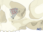 Pediatric medial orbital wall fracture.