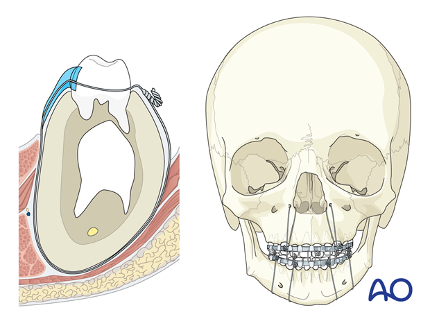 Cross-section and skull showing acrylic splint fabrication bimaxillary fixation with circummandibular wiring/ aperture wiring in pediatrics.