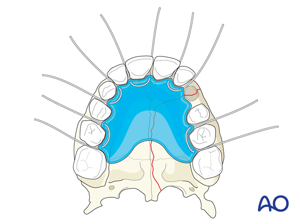 Acrylic splints over arch bars – pediatrics.