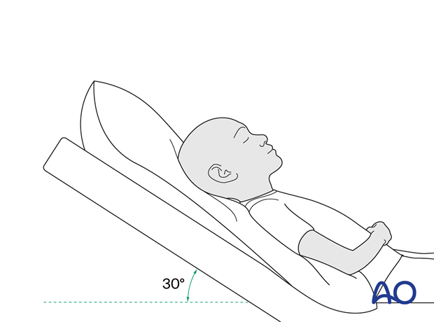 Postoperative pediatric patient positioning with head at 30-degree angulation.