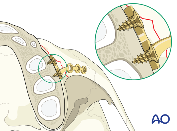 Fixation with small monocortical screws avoiding tooth buds.