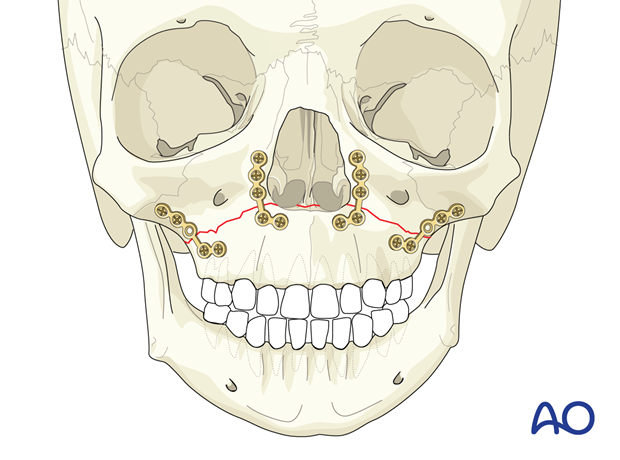 Fixation with plates of a pediatric Le Fort I unilateral comminuted fracture