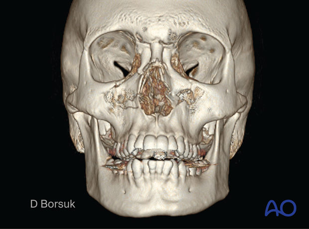 Frontal 3D CT showing a right NOE II and a left NOE I fracture in a pediatric patient.