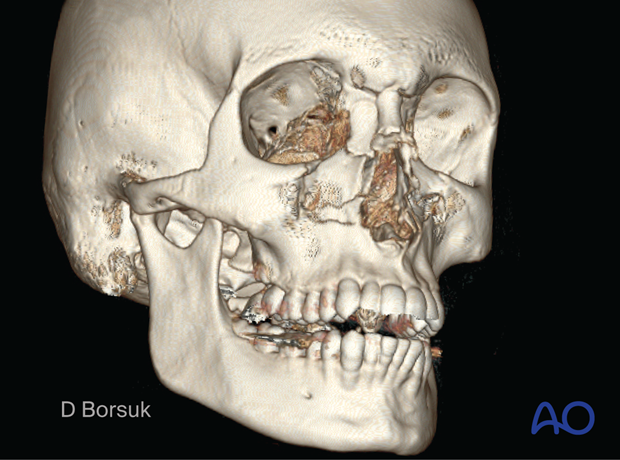 Oblique 3D CT showing a right NOE II and a left NOE I fracture in a pediatric patient.