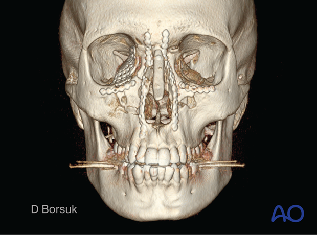Frontal 3D CT showing fixation of a right NOE II and a Left NOE I fracture in a pediatric patient.