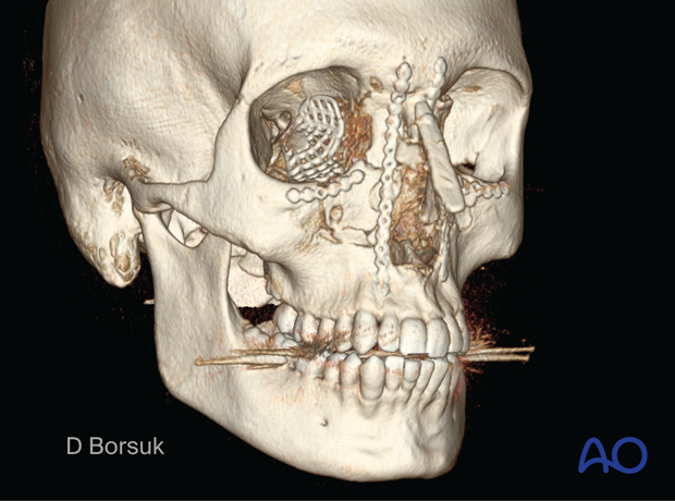Oblique 3D CT showing fixation of a right NOE II and a Left NOE I fracture in a pediatric patient.