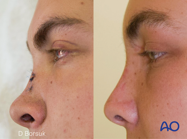 Preoperative lateral clinical photograph showing collapsed upper central midface with a saddle nose deformity in a pediatric patient.