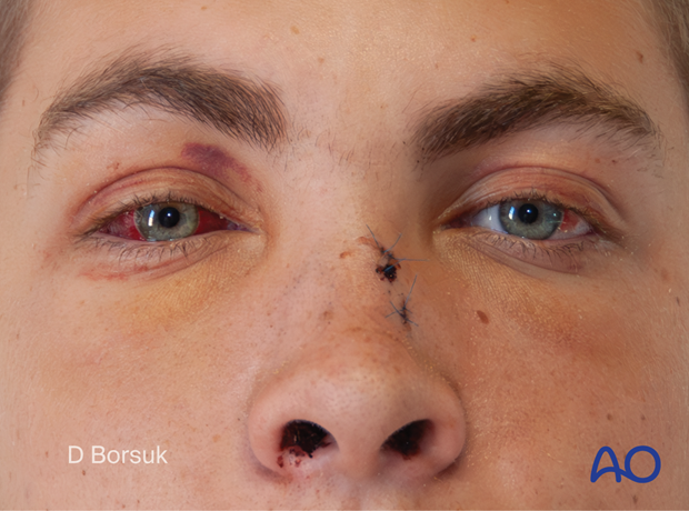 Preoperative frontal clinical photograph showing increased intercanthal distance and upper central facial collapse in a pediatric patient.