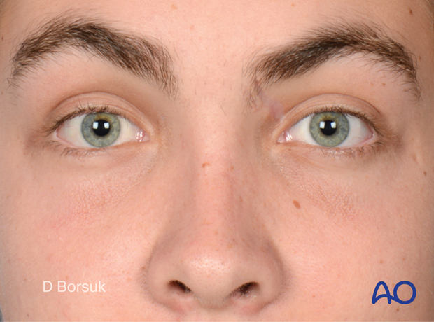 Postoperative frontal clinical photograph restored facial features in a pediatric patient.