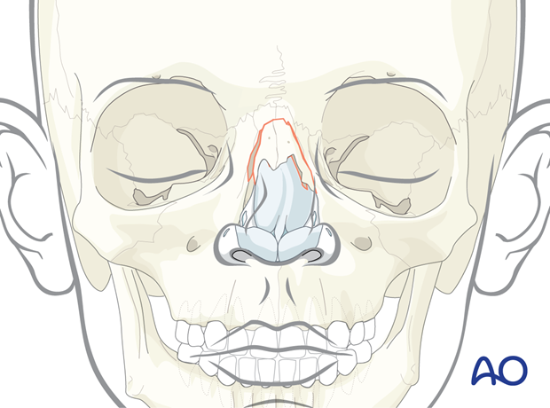 Pediatric greenstick-type nasal bone fracture showing sideways shifting of nasal bone pyramid.