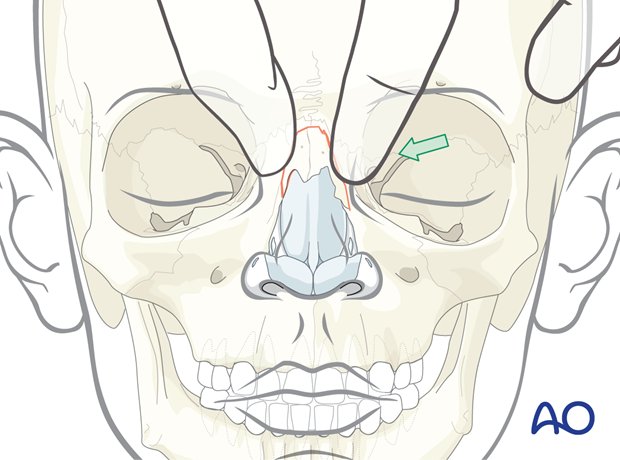 Reduction by external manipulation of a pediatric greenstick-type nasal bone fracture.