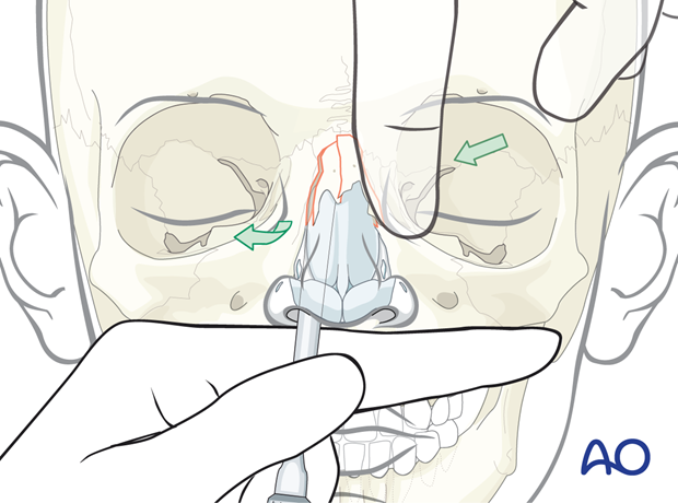 Reduction by intranasal manipulation of a pediatric collapsed nasal bone fracture.