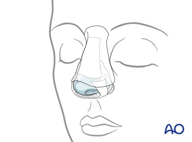 Splinting of a pediatric nasal bone fracture.