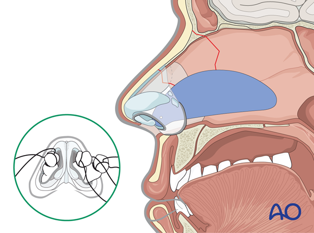 Stabilization with a splint of a nasal bone fracture.