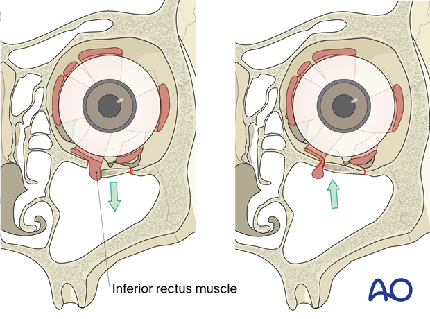 Trapdoor phenomenon in a pediatric orbital floor fracture.