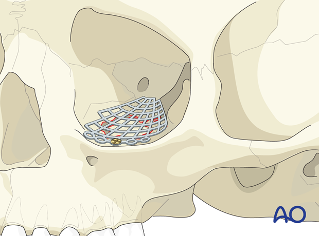 Titanium mesh placement for orbital floor reconstruction.