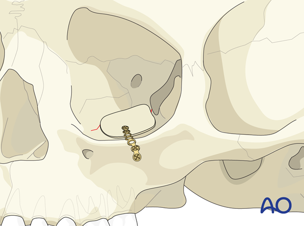 Placement of an individual calvarial bone graft for orbital floor reconstruction.