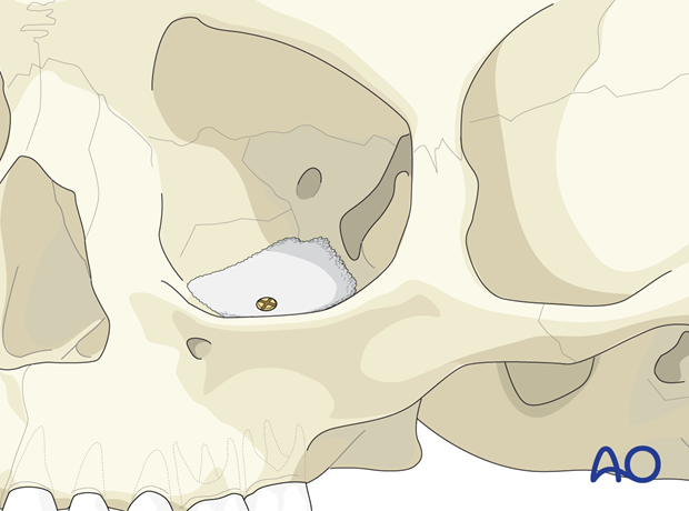 Fixation of an orbital floor fracture using a porous polyethylene sheet.