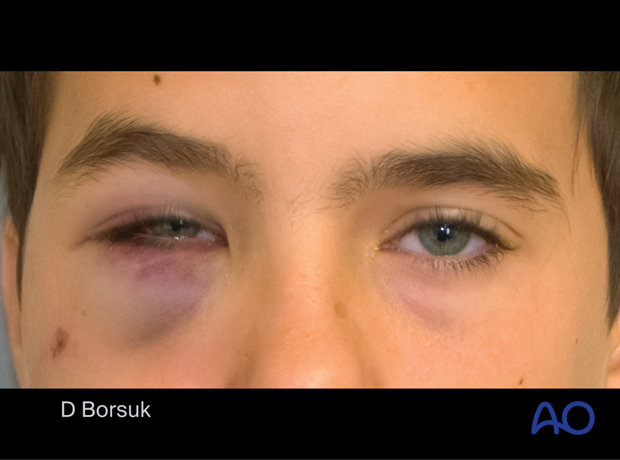 Clinical photograph of a 11-year-old boy with a right orbital blowout fracture.