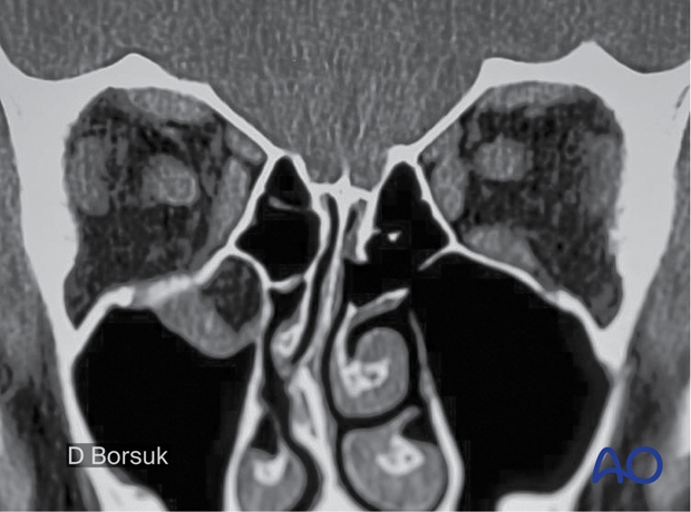 Coronal view on a CT scan showing the entrapment of the right inferior rectus muscle – 11-year-old boy.