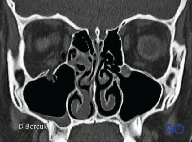 Coronal view on a CT scan showing the entrapment of the right inferior rectus muscle – 13-year-old boy.