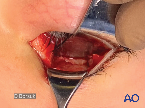 Clinical photograph showing the transconjunctival approach to the orbital floor.