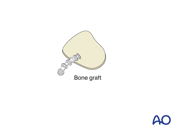 An individual calvarial bone graft for orbital reconstruction.