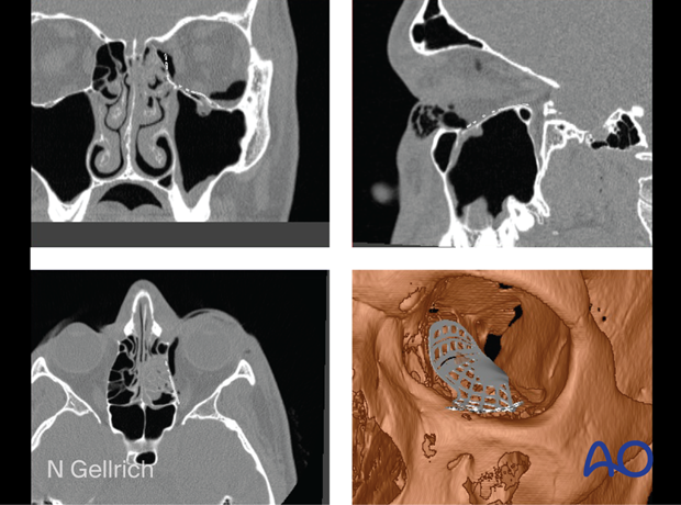 Multiplanar and 3D view showing a preformed mesh plate placed before orbital reconstruction surgery.