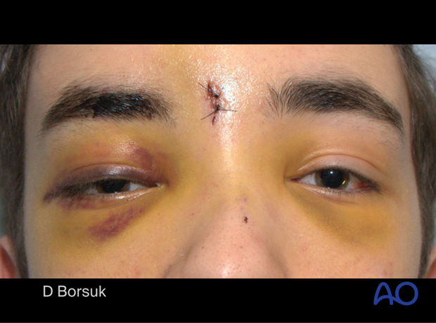 Clinical photograph of a 16-year-old boy with a right orbital roof and frontal bone fracture.