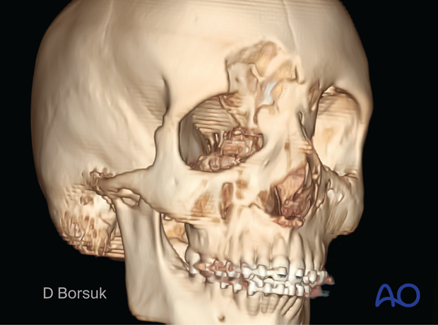 3D CT reconstruction showing the intraorbital displacement of the orbital roof fracture.