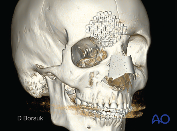 3D CT reconstruction showing titanium mesh reconstruction of the orbital roof fracture.