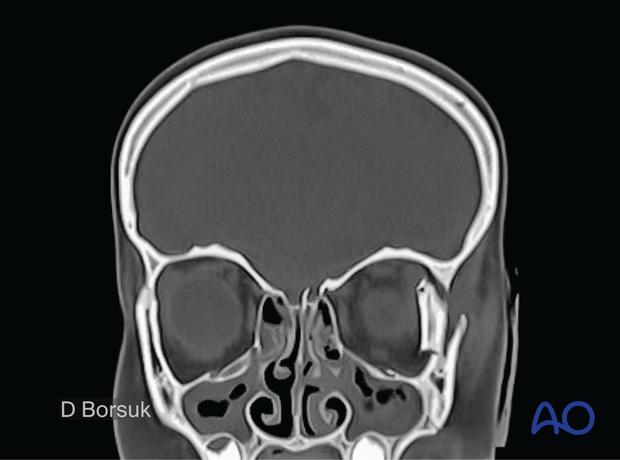 p92 525 Open treatment