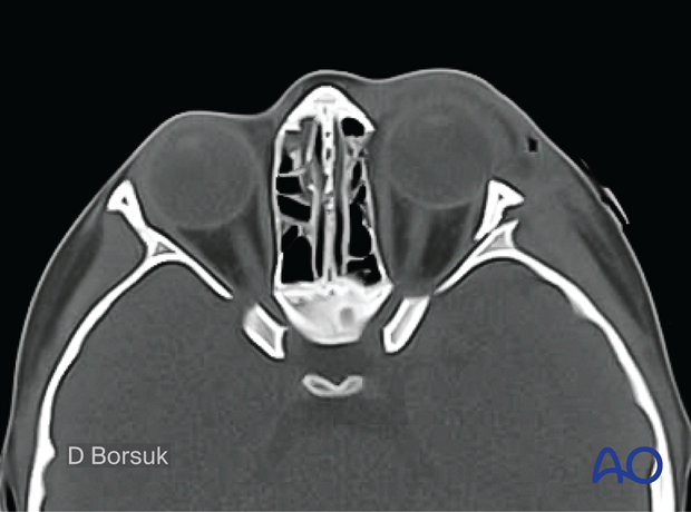 Axial view on a CT scan showing compression of the left lateral rectus muscle – 6-year-old girl