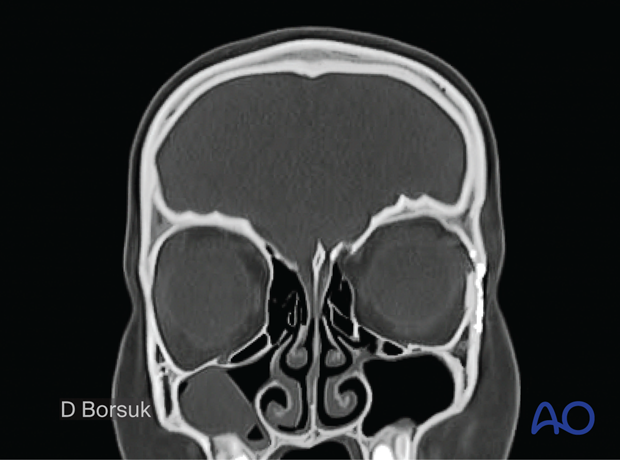 4-year postoperative sagittal scan demonstrating normal orbital anatomy with titanium plate reconstruction