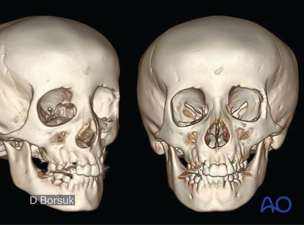 4-year postoperative 3D scan demonstrating normal orbital anatomy with a complete remodeling of lateral orbital wall.