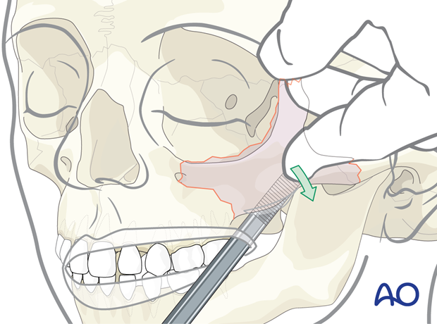 p92 P645 orif without orbital reconstruction