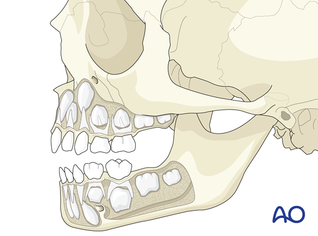 Tooth buds in the pediatric maxilla and mandible.