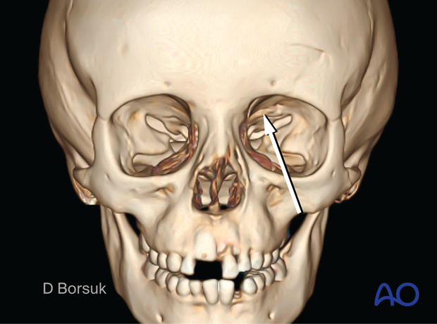 3D CT scan showing a depressed greenstick skull and upper orbit fracture in a pediatric patient.